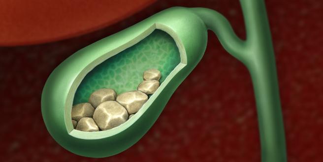 Gallensteine Cholelithiasis