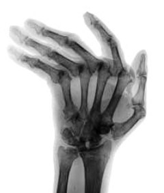 Rheumatoide Arthritis Hand Rheuma Hand