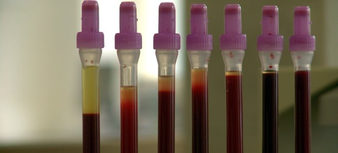 Chlorid im Blut Blutröhrchen im Labor