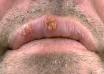 Lippenherpes Lippenherpes
