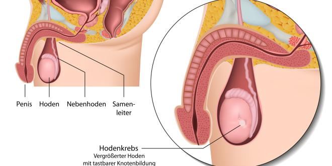 Hodenkrebs Hodenkarzinom