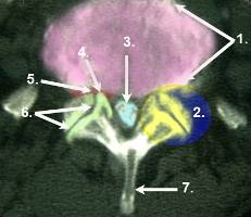 Spondylarthrose CT Abbildung Spondylarthrose
