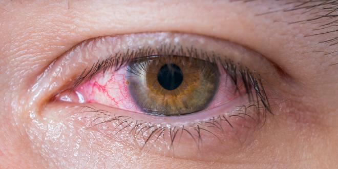 autoimmunbedingte Augenerkrankungen Augenerkrankungen durch Autoimmunerkranmkungen - gerötetes Auge