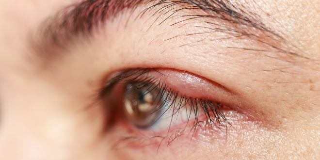 Infektion infiziertes Auge