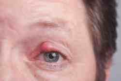 Augenherpes