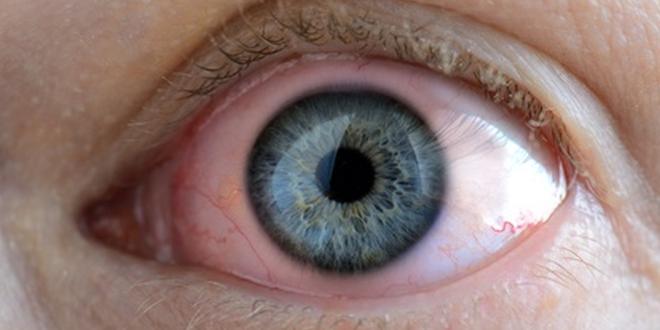 Gerötete Augen Gerötetes Auge