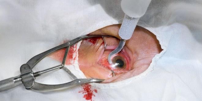 Transplantation der Hornhaut Hornhaut-Tx
