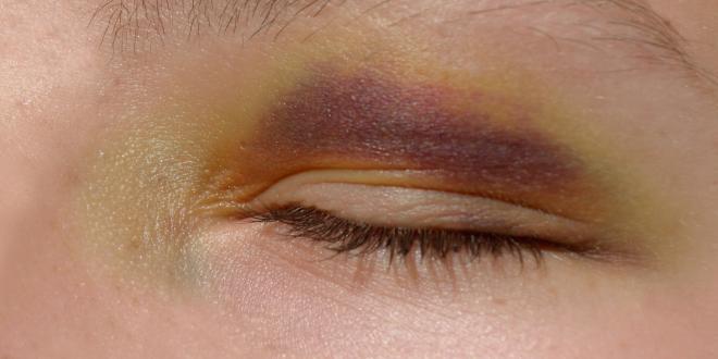 Blaues Auge - Was tun?