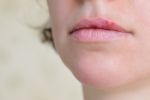 Herpes an der Lippe Bild klein
