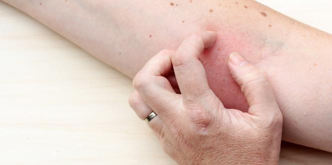 Milbenallergie Juckende Haut