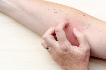 Hautausschlag nach Antibiotika Hautausschlag nach Antibiotika