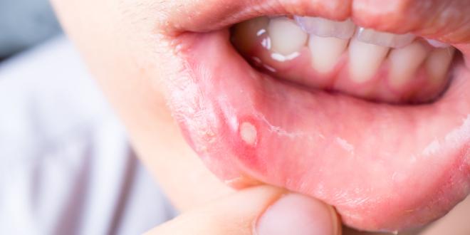 Leukoplakie Leukoplakie