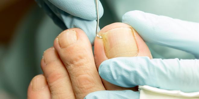 Nagelpilz