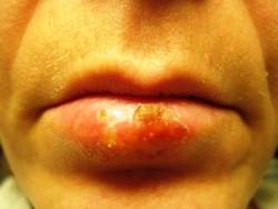 Herpes Herpes simplex