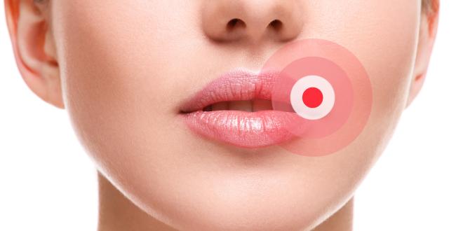 Herpes Simplex Herpes Simplex