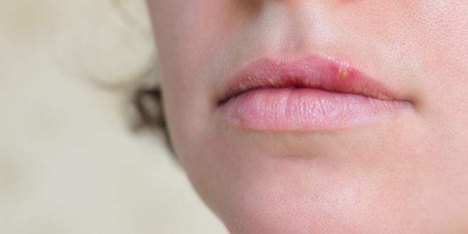 Herpes im Mund