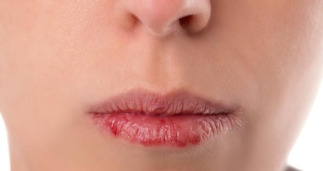 Trockene Lippen Ursachen