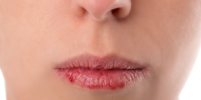 trockene Lippen trockene Lippen