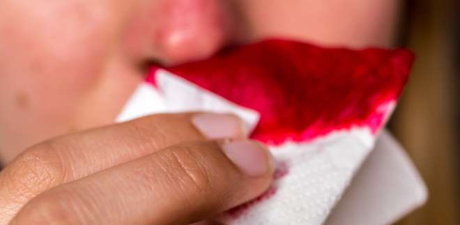 Ursachen für Nasenbluten Epistaxis
