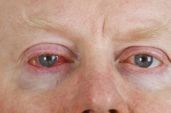 Gürtelrose am Auge