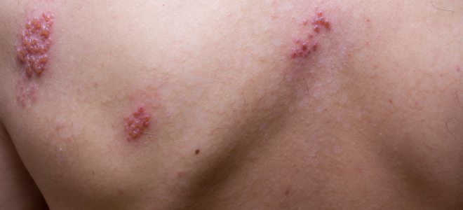 Ist eine Gürtelrose ansteckend? Gürtelrose ansteckend