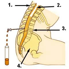 Liquordiagnostik schematisch dargestellt Abbildung Liquordiagnostik
