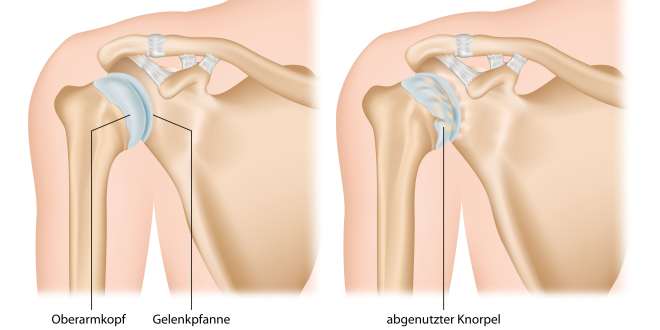 Der Verlauf von Arthrose
