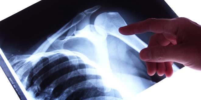 Diagnose der Arthrose