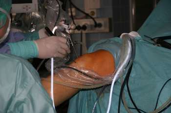 Gonarthrose Gelenkspiegelung Gonarthrose Arthroskopie