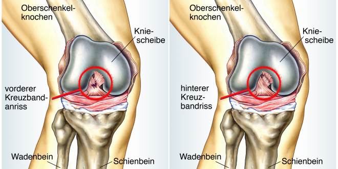 Hinterer Kreuzbandriss Die Anatomie des hinteren Kreuzbandrisses