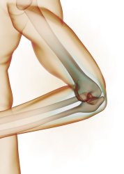 Osteonekrose Osteonekrose