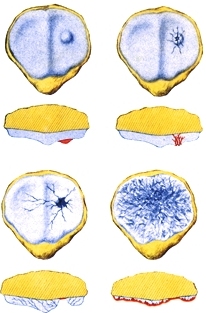 Abb. Retropatellararthrose Retropatellararthrose