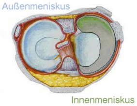 Meniskusschaden