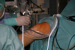 Arthrofibrose