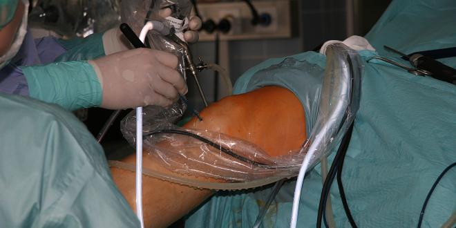 Arthroskopie im Kniegelenk
