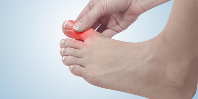 Hallux rigidus