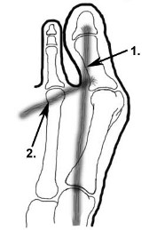 Abbildung Hallux valgus Abbildung Hallux valgus