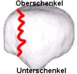 Kniescheibenbruch längs Kniescheibenbruch längs