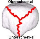 Kniescheibenbruch Kniescheibenbruch quer