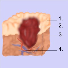Schichten der Magenschleimhaut mit Magengeschwür Schichten der Magenschleimhaut mit Magengeschwür