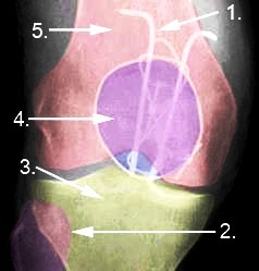 Röntgenbild Patellafraktur Röntgenbild Patellafraktur