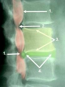 Röntgenbild / Myelographie einer Spinalkanalstenose Röntgenbild / Myelographie einer Spinalkanalstenose