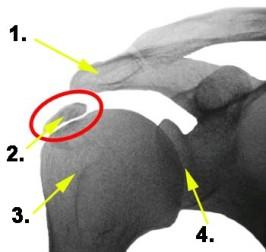 Tendinosis calcarea der Schulter Tendinosis calcarea der Schulter