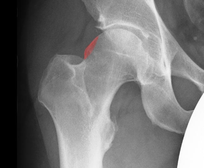CAM-Impingement CAM-Impingement