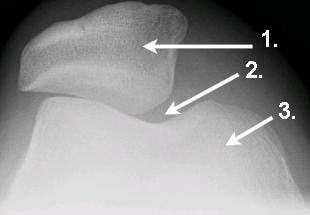Lateralisation der Patella Lateralisation der Patella