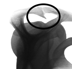 Röntgenbild Schulter bei Impingement Röntgenbild Schulter bei Impingement