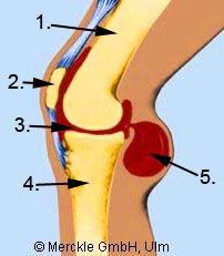 Zyste Seitlich Am Knie Zyste Seitlich Am Knie