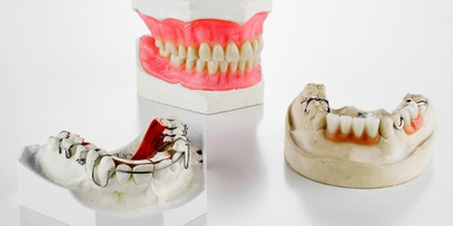 Für die Herstellung von Zahnersatz sind Modelle nötig, die durch den Abdruck entstehen.