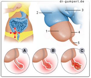 Abbildung Blinddarmentzündung