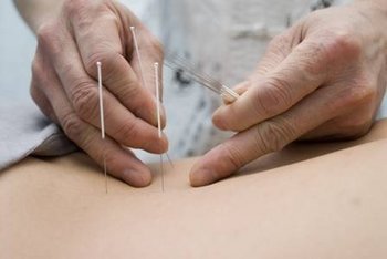 Akupunktur und Geburtsvorbereitung